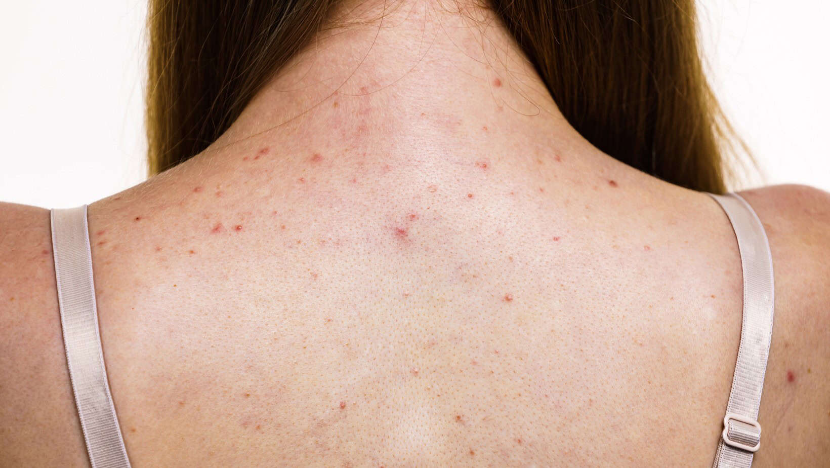 Body Acne Explained – Expert Tips, Key Ingredients, and the Best Body Washes