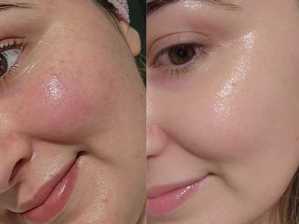 How I Repaired My Skin Barrier With 4 Soothing Products