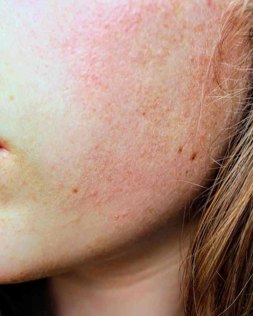Close-up of facial skin showing freckles, redness, and skin texture for skincare insights.