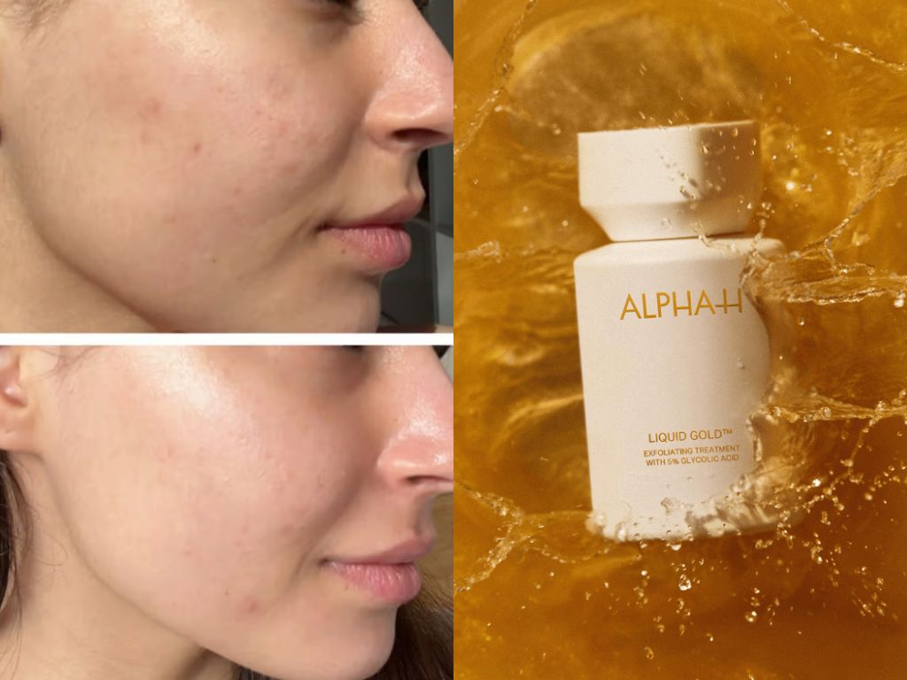 Alpha-H Liquid Gold Review: What Happened When My Sensitive Acne-Prone Skin Finally Tried It